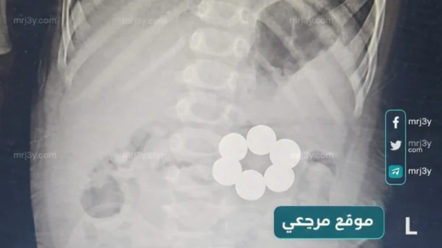 إنقاذ رضيع ابتلع مغناطيس دون جراحة